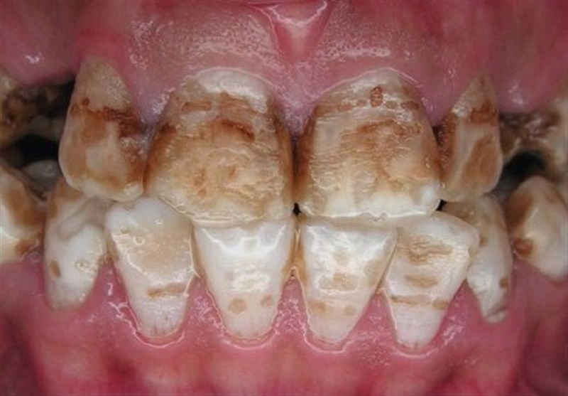 حساسیت‌ عاج دندانی چیست؟ علائم و توصیه‌ها