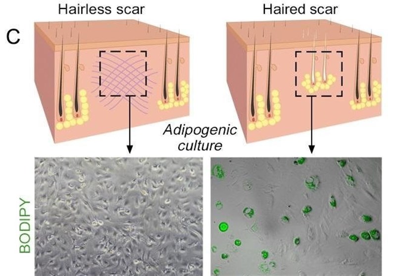 Using Fat to Help Wounds Heal without Scars