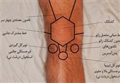 روشی نوین در بهبود آرتروز زانو در ایران /خط اول درمان بیماریهای تاندونی چیست؟