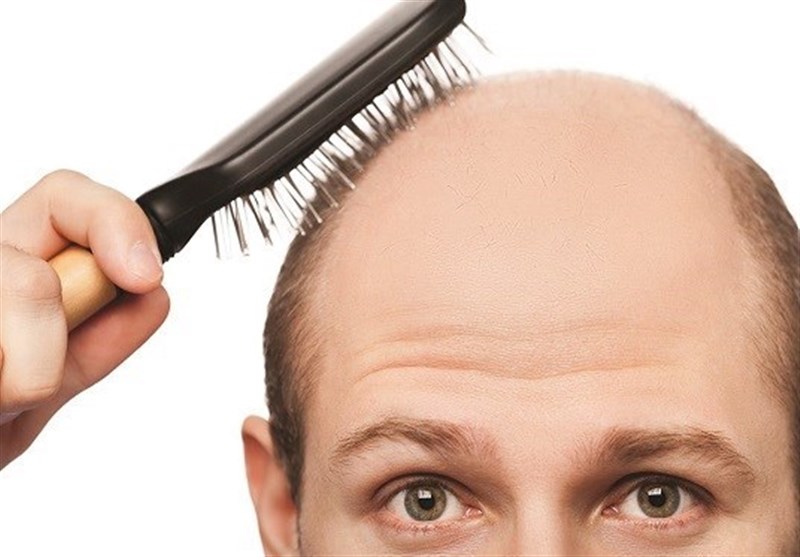 اثبات وجود رابطه مستقیم بین میزان ساعت کاری با ریزش موی سر!