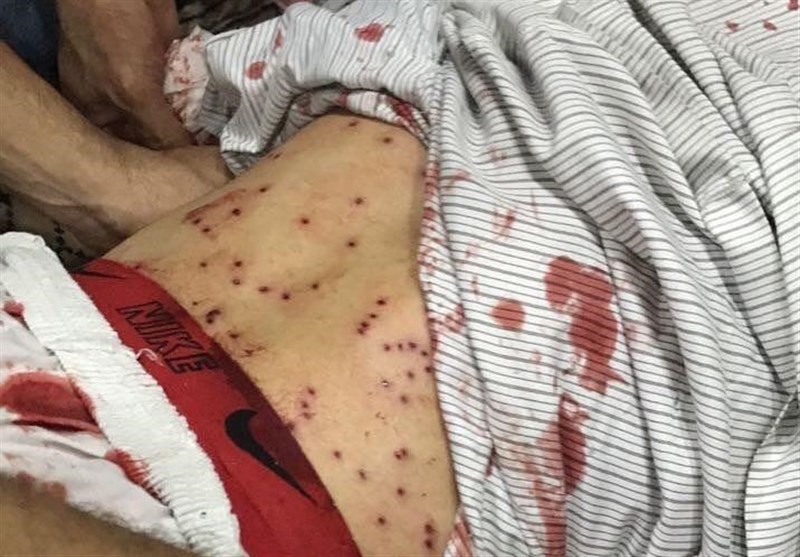 نقض حقوق بشر در بحرین| شیوع بیمارهای پوستی در زندان مرکزی &quot;جو&quot;