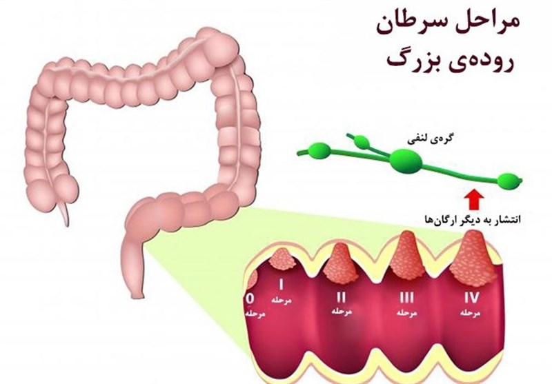 نوعی بیماری که باید هر سه سال آزمایش خون مخفی داد