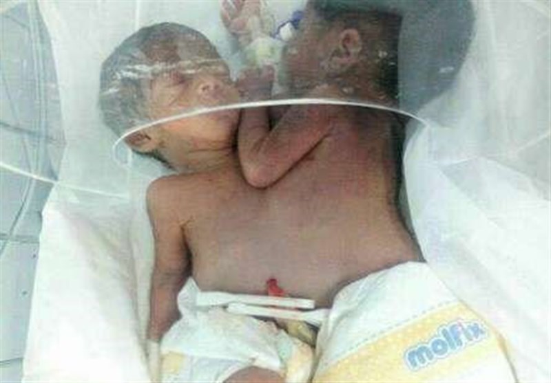 دوقلوهای به‌هم چسبیده نیکشهری فوت شدند