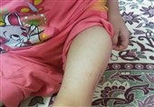 «تانیا» دختر افغانستانی تحت درمان قرار می‌گیرد