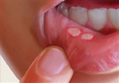 چگونه «آفت دهان» را درمان کنیم