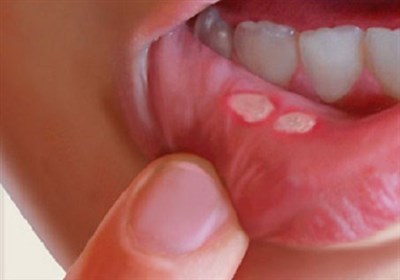  چگونه "آفْت دهان" خود را با چند راهکار طب سنتی درمان کنیم؟ 