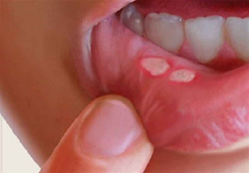 Image result for ‫توضیحات درباره التهاب دهان‬‎
