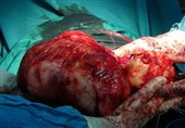 توده بیمار قمی