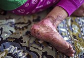 سه بیماری در ایران که تا 5سال آینده به نصف کاهش می‌یابد