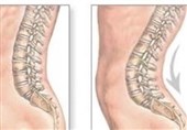 عدم‌درمان &quot;یبوست&quot; باعث ابتلا به گودی کمر