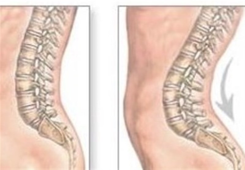 عدم‌درمان &quot;یبوست&quot; باعث ابتلا به گودی کمر