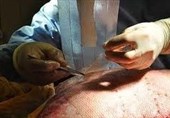 شیراز|ماهیانه 70 عمل پیوند پوست انجام می‌شود