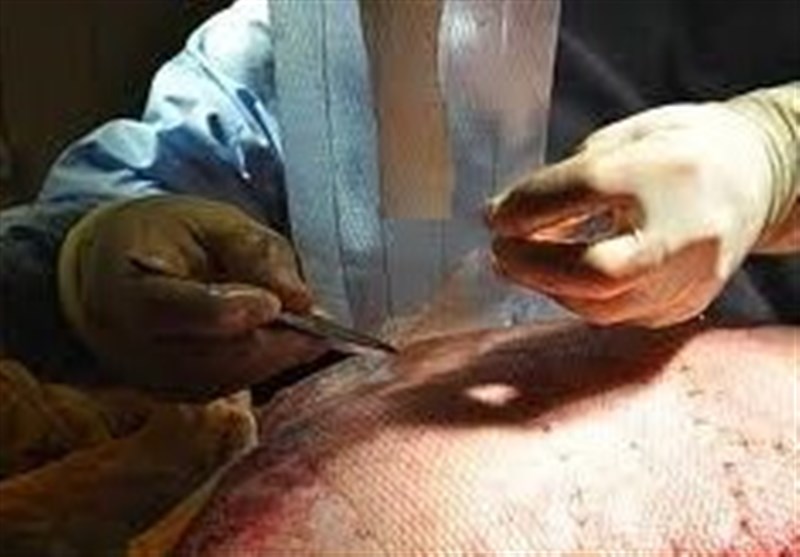 مشهد| آمار فوتی‌های بیماران سوختگی بیمارستان امام رضا (ع) 50 درصد کاهش یافت