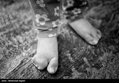 استان گلستان- بخش گلیداغ،روستای قوشا سوباد یالی،یاسمن مرادی 4 ساله ،پدر مادر او دخترعمو پسرعمو هستند.او از زمان تولد یک چشم نداشته و انگشتای پاهایش به هم چسبیده است.