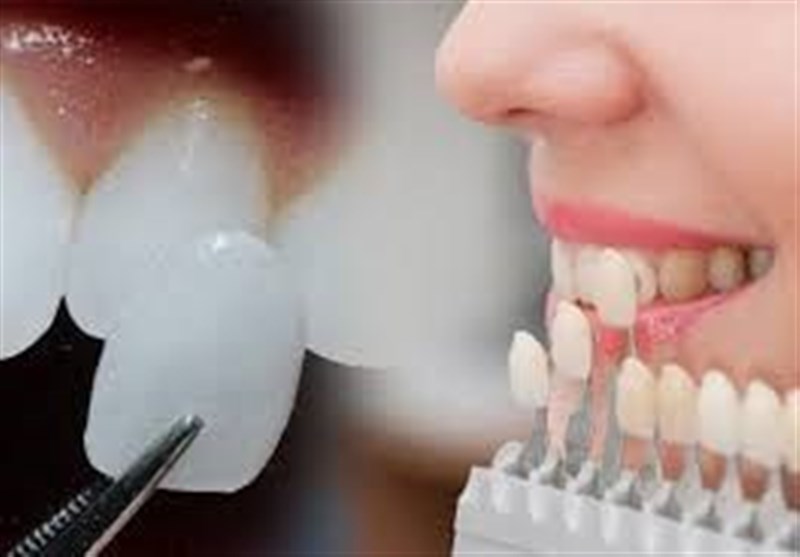 مناسب‌ترین شیوه تغییر فرم دندان‌ها به جای ارتودنسی+جزئیات