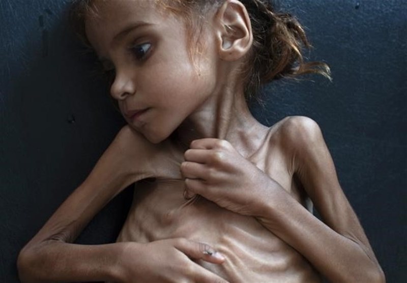 Starving Girl Who Became Symbol of Yemen Crisis Dies