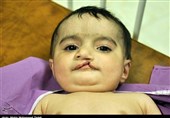 جراحی رایگان 373 مبتلا به بیماری شکاف کام و لب در ایلام انجام میشود