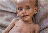 جان باختن 85 هزار کودک در یمن به دلیل سوء تغذیه
