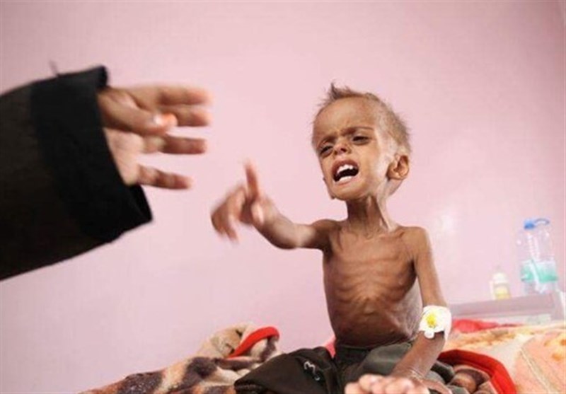 قرابة 85 ألف طفل ماتوا بسبب سوء التغذیة الحادّ خلال الحرب على الیمن