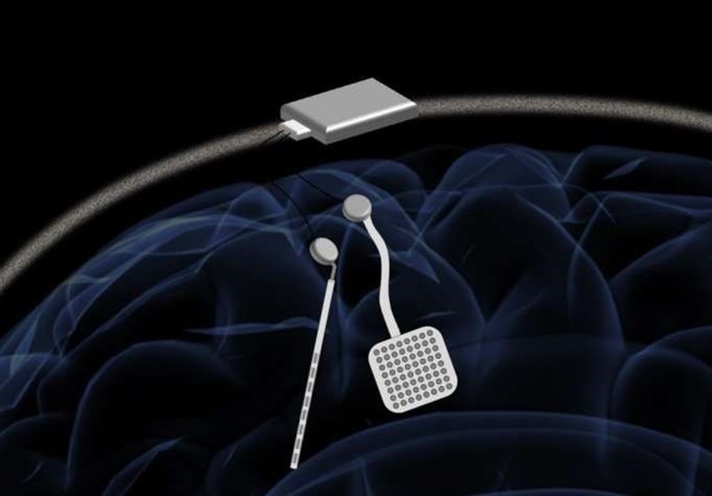 New Treatment for Neurological Disorders with Wireless &apos;Pacemaker for Brain&apos;