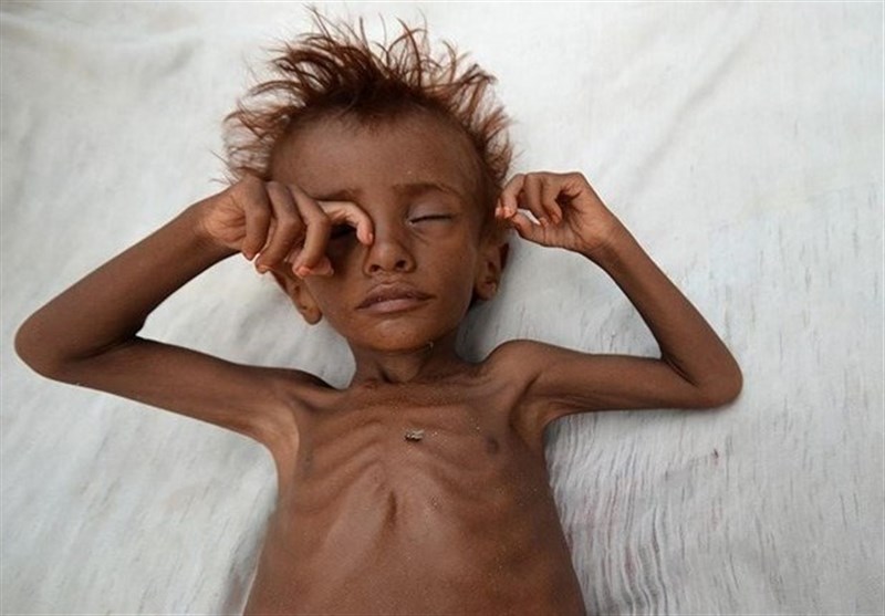 UNICEF 92 Of Babies In Yemen Are Underweight At Birth World News   139803021453548717489974 