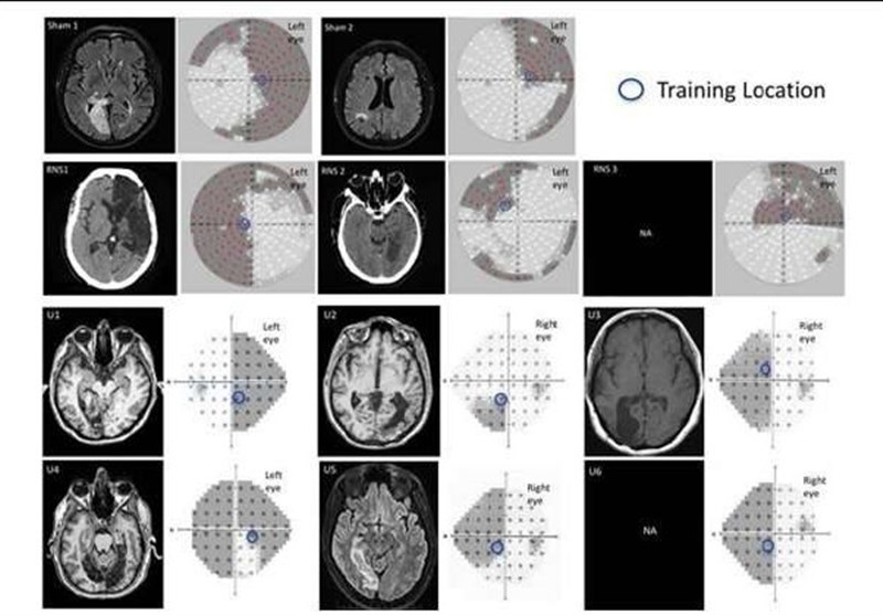 Visual Learning Efficiency Enhanced with Brain Stimulation