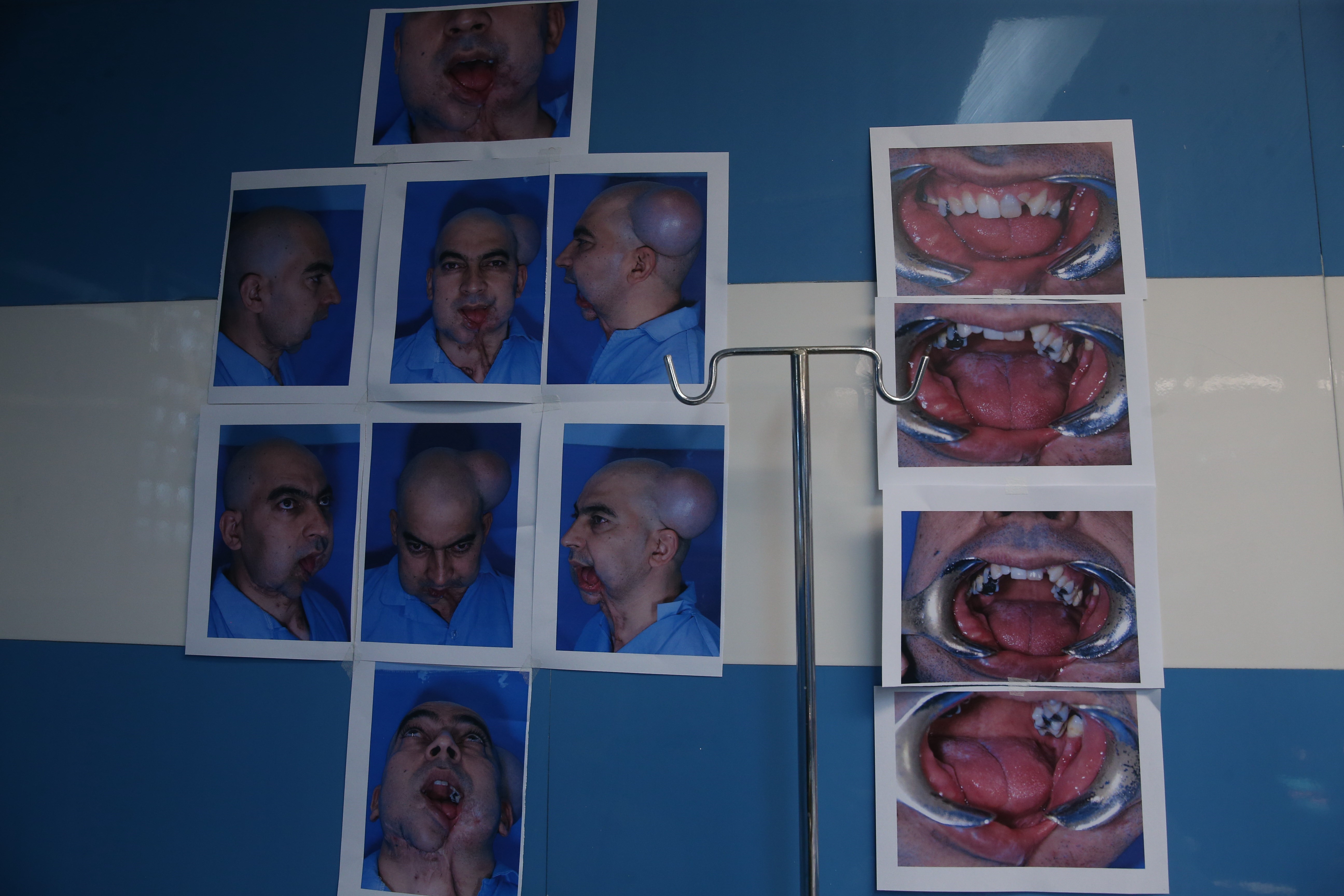 انجام جراحی منحصر‌به‌فرد بازسازی فک و صورت در بیمارستان آیت‌الله طالقانی