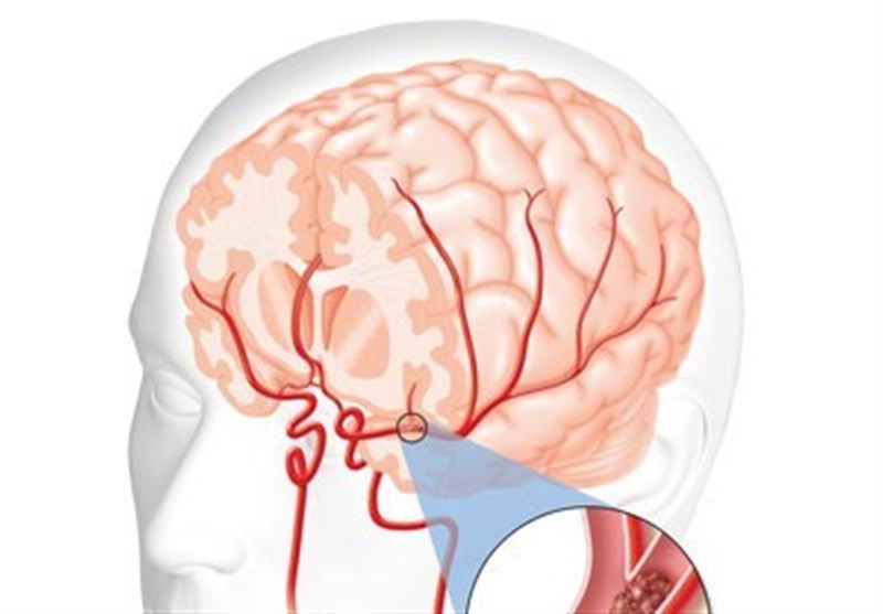 Brain 167. Синусопатия головного мозга. ВББ В медицине. Цереброваскулярная недостаточность.