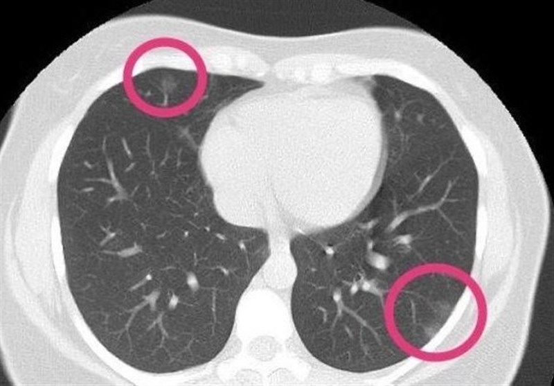 Scan Finds Coronavirus in Lungs of Healthy Woman with No Symptoms