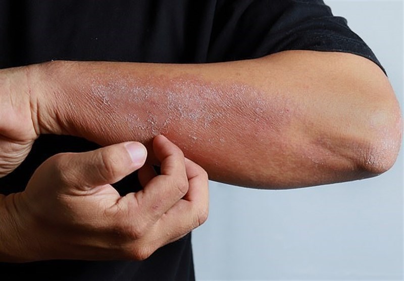 Skin Rashes Should Be Added to List of COVID-19 Symptoms
