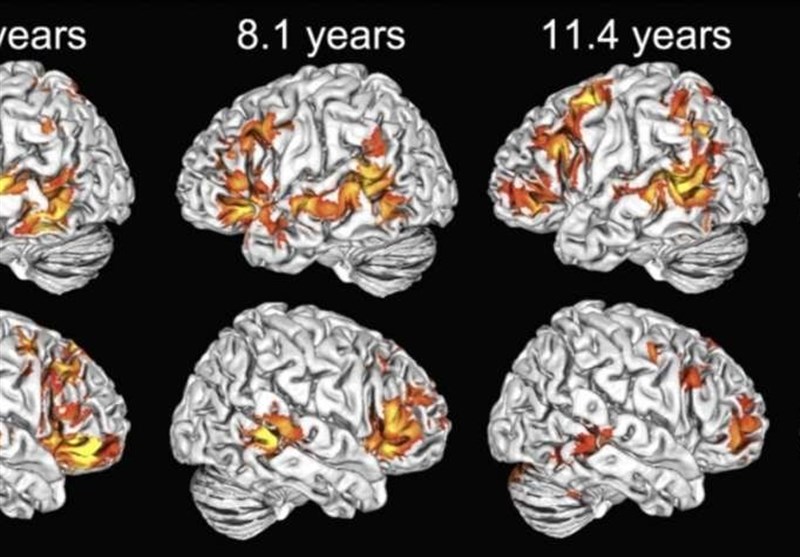 Children Use Both Brain Hemispheres to Understand Language