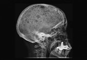 Perforated Bone Tissue Made from Too Little Sugar