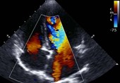 Chance of Death from Coronavirus Grows with Damage to Heart&apos;s Right Ventricle