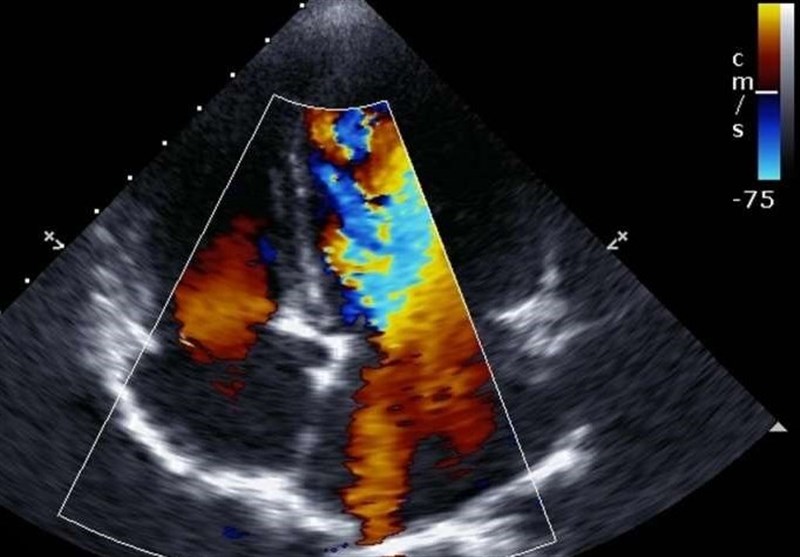 Chance of Death from Coronavirus Grows with Damage to Heart&apos;s Right Ventricle