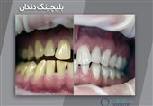 بلیچینگ دندان چیست؛ با روشهای انجام آن آشنا شوید