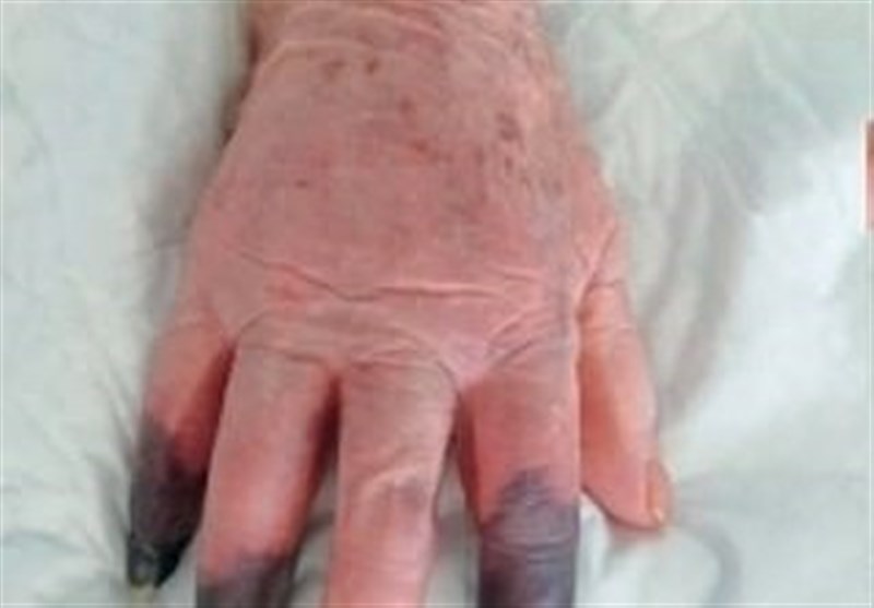 Woman’s Fingers Amputated After COVID Infection Turned Them Black