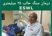 سنگ شکنی حالب