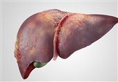 درمان بیماران هپاتیت C رایگان شد