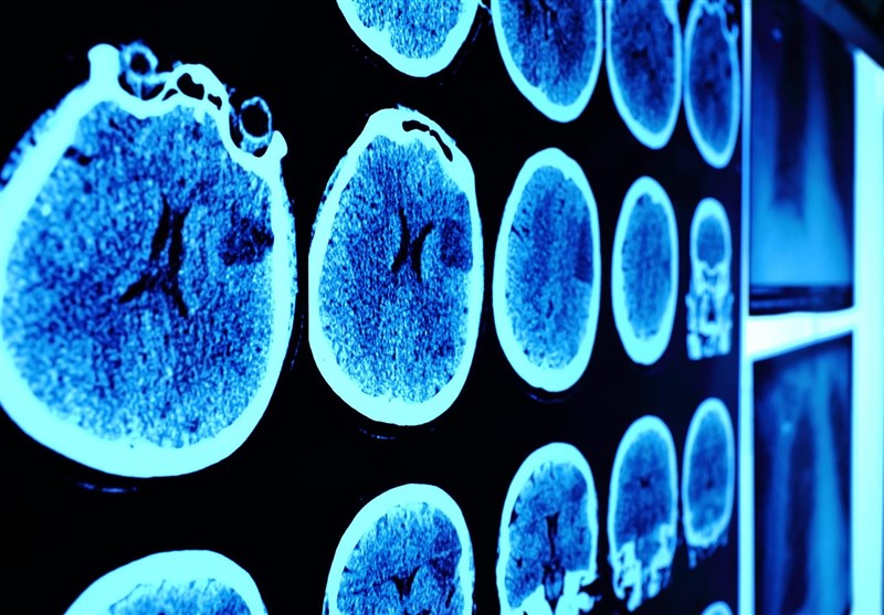کاهش حجم ماده خاکستری مغز در بیماران حاد ویروس کرونا