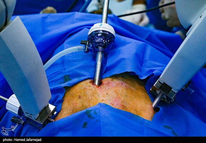 انجام اولین عمل جراحی رباتیک و از راه دور در ایران