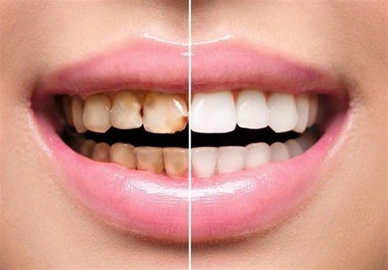 یک بار برای همیشه تفاوت بین کامپوزیت دندان و لمینت دندان را بخوانید