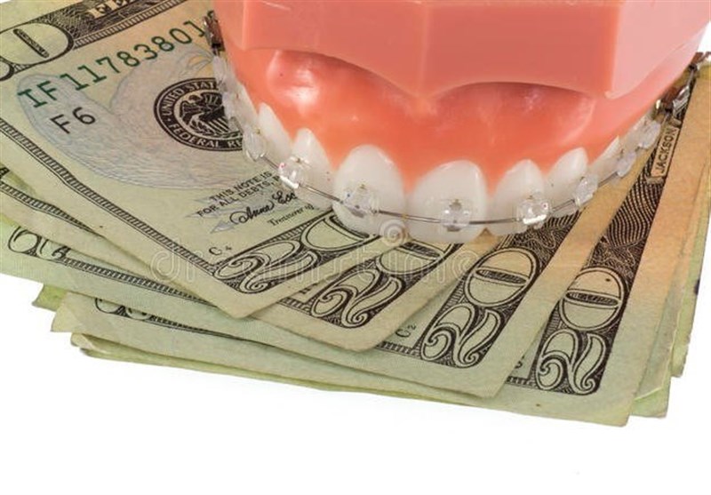 5 دلیل که چرا هزینه ارتودنسی دندان زیاد و سرسام آور است
