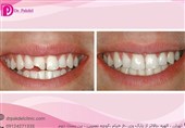 کامپوزیت دندان چیست؟ تفاوت کامپوزیت و لامینیت