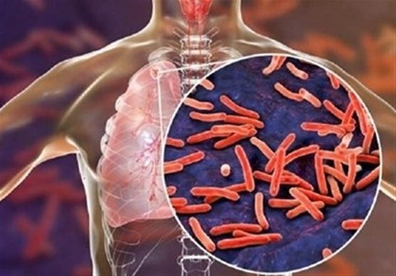وزارت بهداشت: شیوع کرونا باعث کاهش تشخیص بیماری سل در کشور شده است