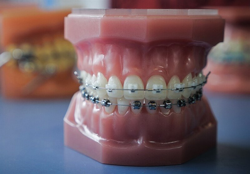 آشنایی با 7 گام اساسی در مراحل ارتودنسی دندان