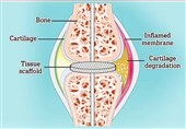 Electric Knee Implants Could Help Treat Pain of Osteoarthritis