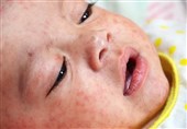 ممانعت برخی والدین کاشانی از واکسیناسیون کودکان / بروز اپیدمی سرخک سرعتی بالاتر از امیکرون دارد