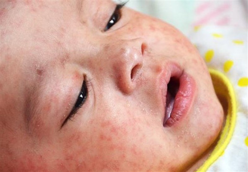 360 هزار کودک اتباع خارجی در استان خراسان رضوی واکسن سرخک دریافت کردند