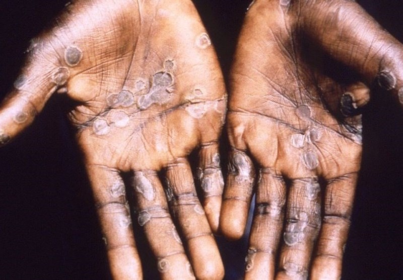 Over 200 Cases of Monkeypox Worldwide: EU Disease Agency