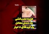 فیلم| هزینه عصبکشی یک دندان معادل یک گرم طلای 18 عیار!